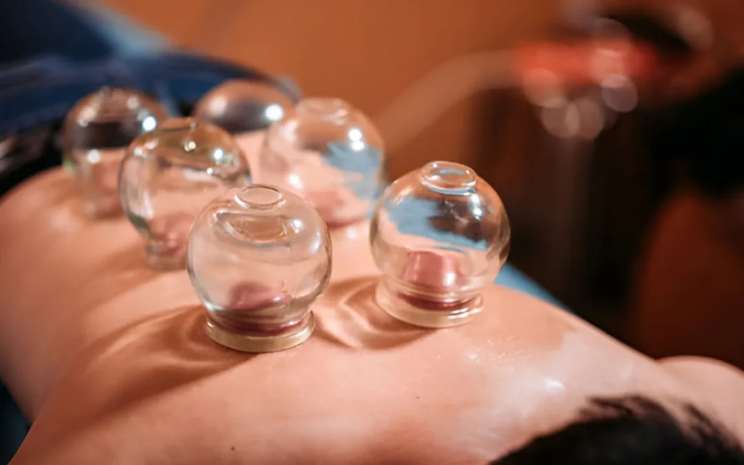 Best Cupping Therapy in Melbourne for Muscle Pain Relief