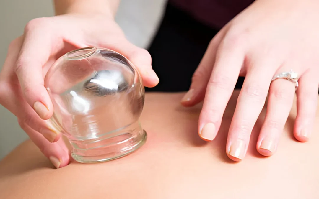 Where to Get Cupping Therapy in Melbourne