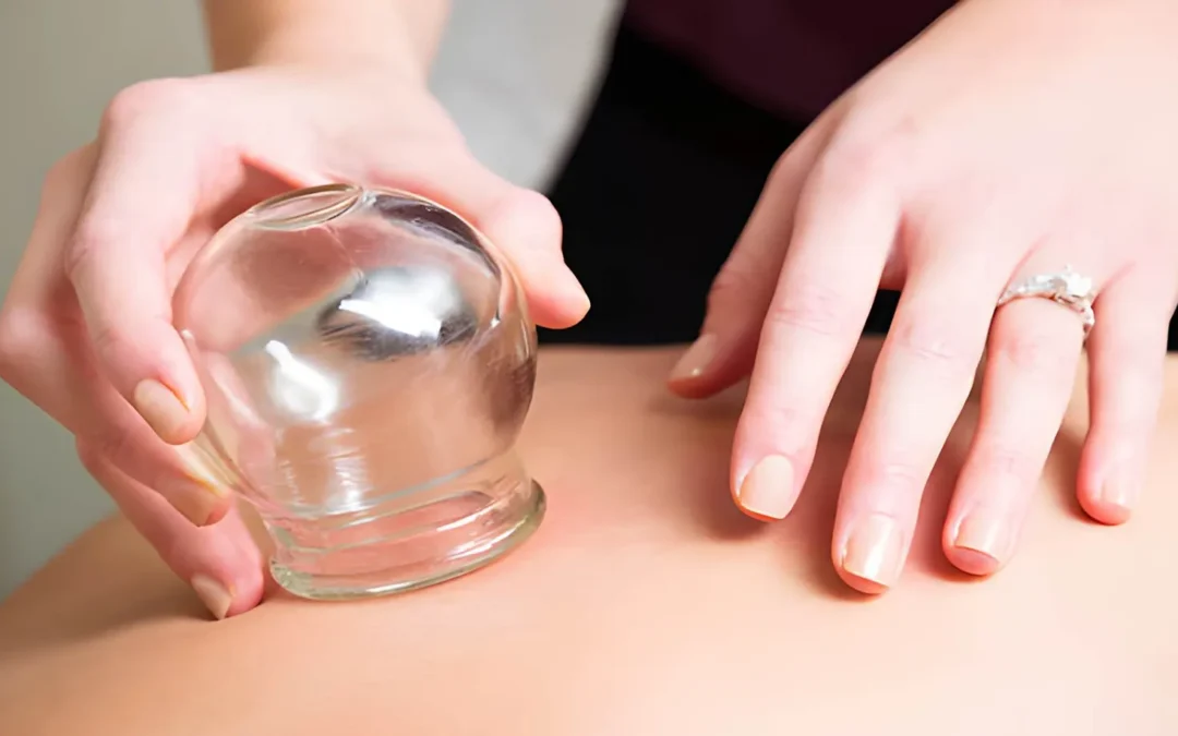 Best Cupping Therapy Melbourne CBD