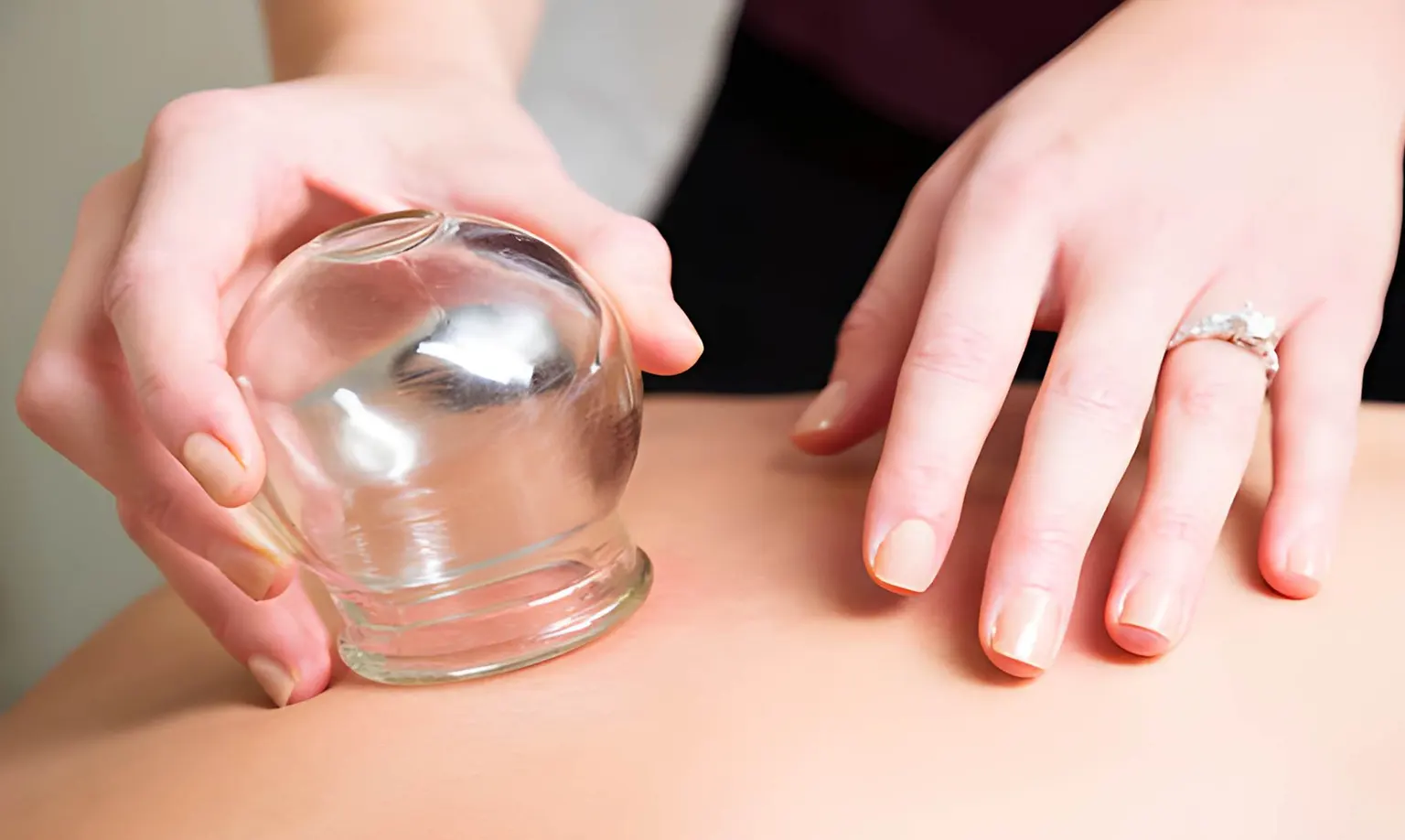 Best Cupping Therapy Melbourne CBD