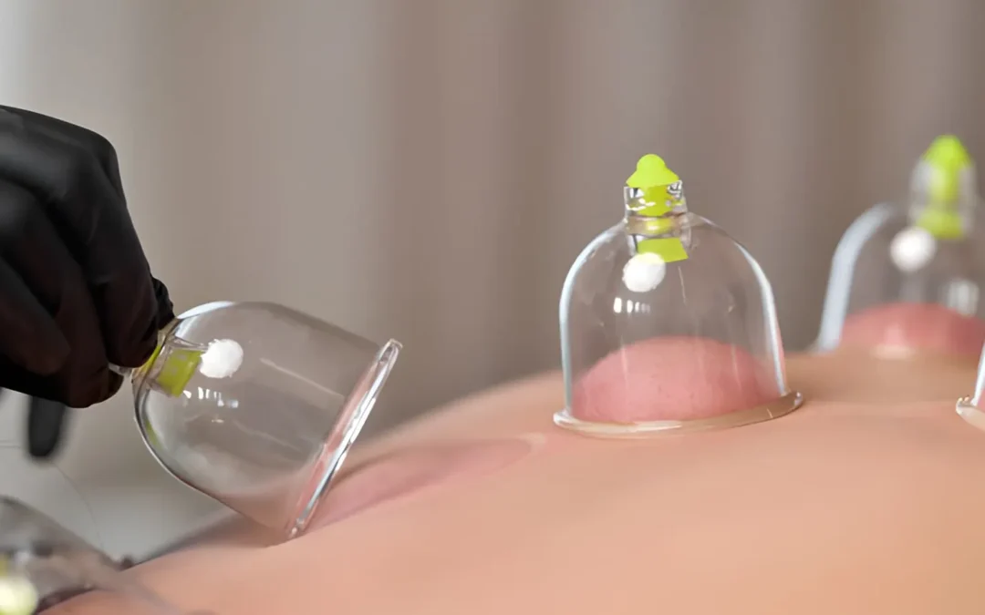 Cupping Therapy Treatment Near Melbourne CBD