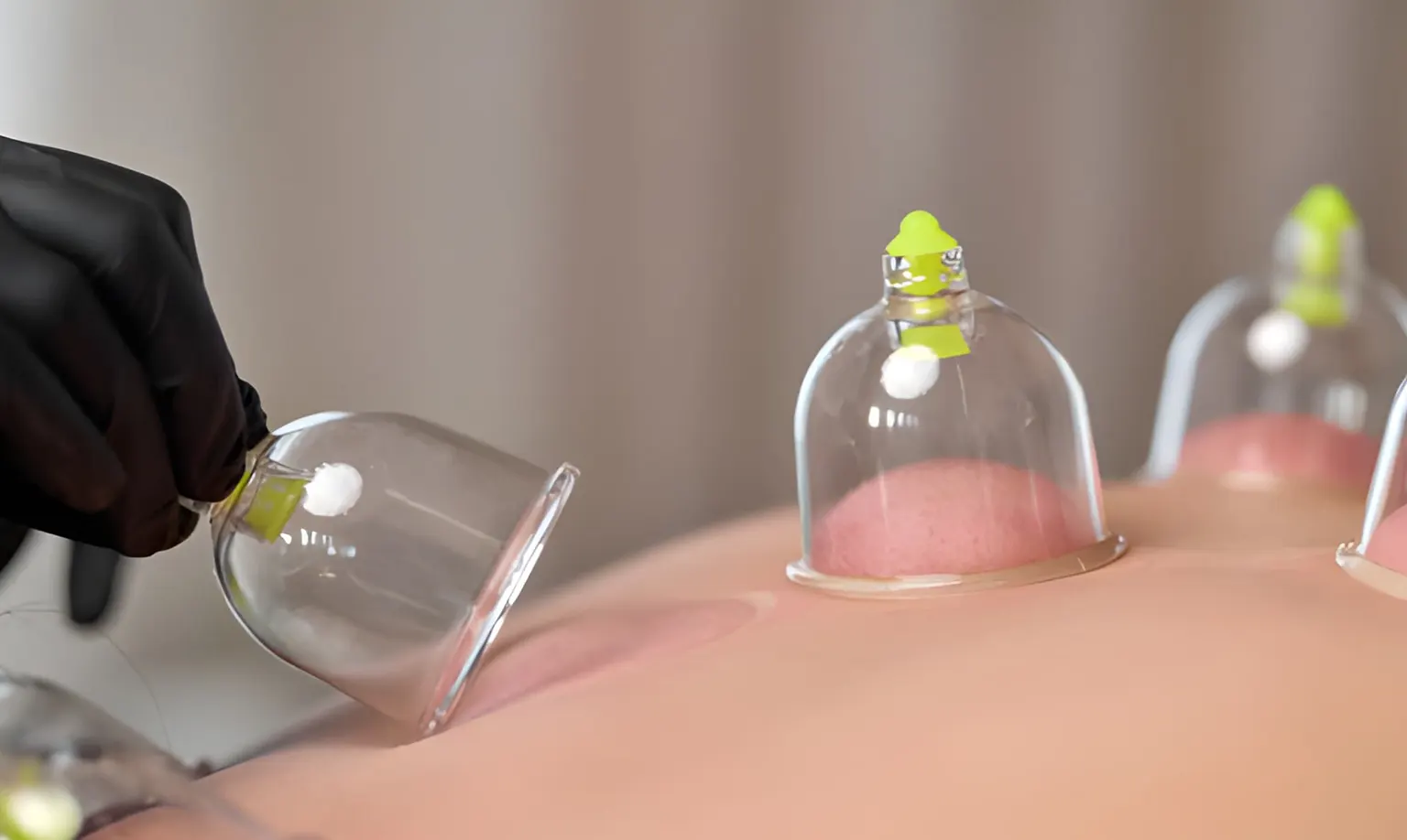 Cupping therapy treatment near Melbourne CBD Cupping Therapy Treatment Near Melbourne CBD