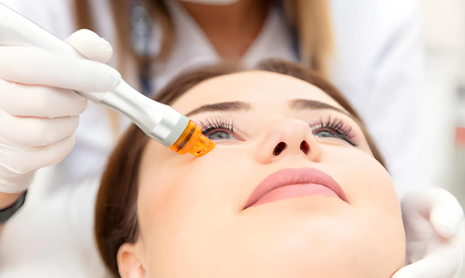 Skin needling treatment services in Melbourne
