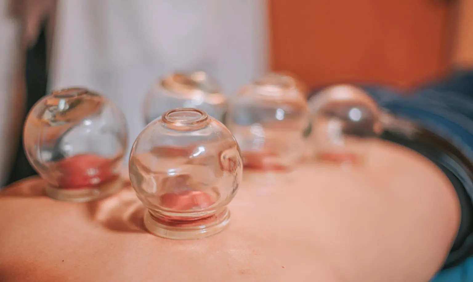 Affordable cupping therapy services Melbourne Affordable Cupping Therapy Services Melbourne