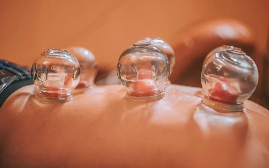 Where to Get Cupping Therapy in Melbourne CBD