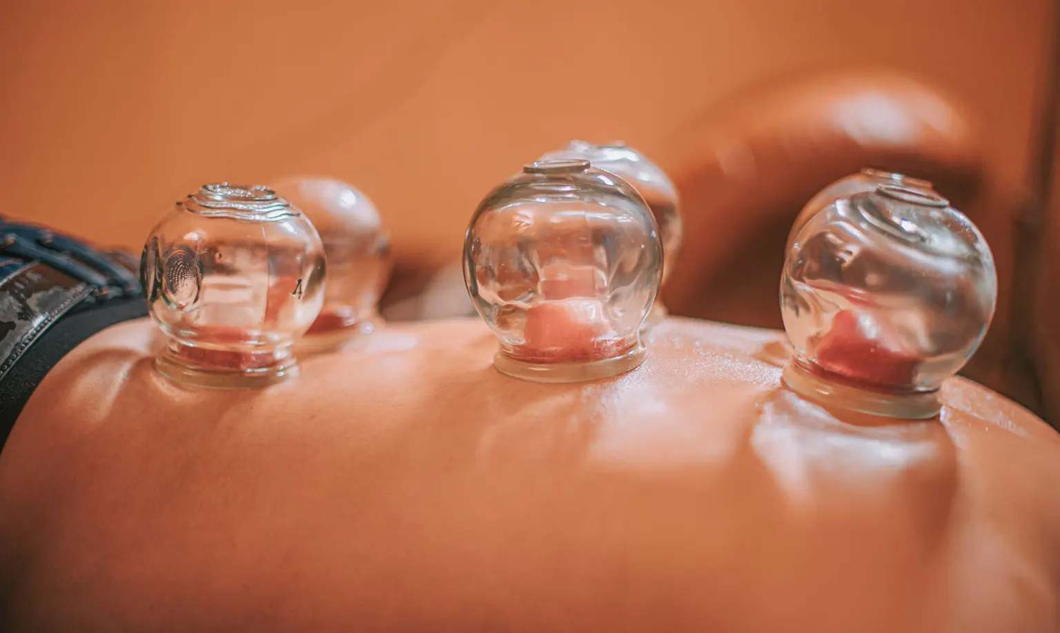 Where to Get Cupping Therapy in Melbourne CBD